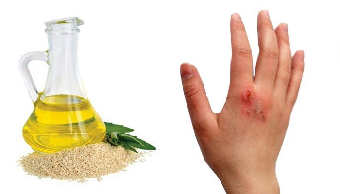 تأثیر ترکیب روغن کنجد و کدو تنبل  بر روی زخم های ناشی از سوختگی درجه سوم